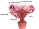 endometriozis diyagram