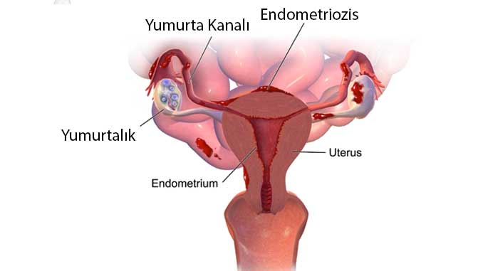endometriozis diyagram